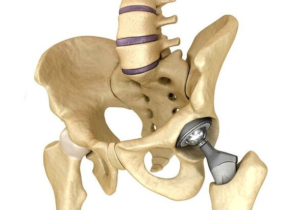 Endoprosthetic hip joint