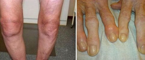 appearance of joints with osteoarthritis