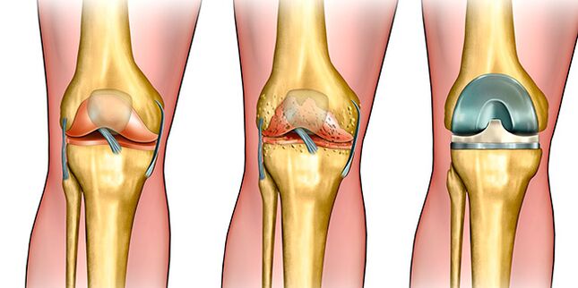 In the third stage of osteoarthritis, knee replacement is required