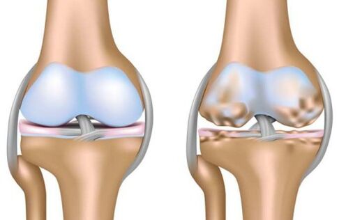 healthy joint and knee joint destruction in osteoarthritis