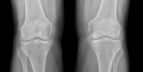 knee osteoarthritis radiography