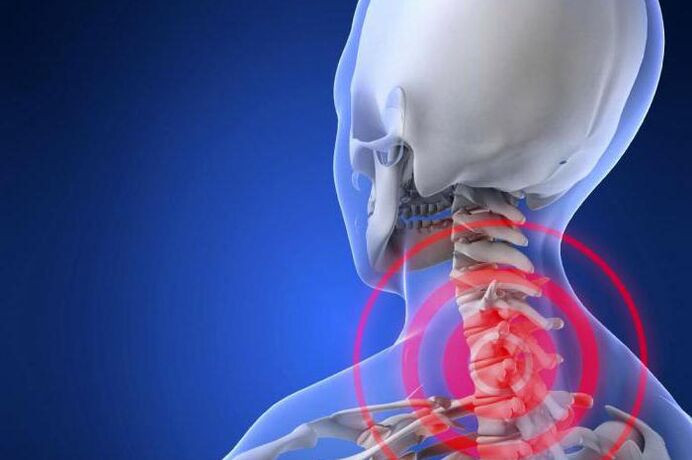 Neck shooting pain - an early symptom of cervical osteochondrosis