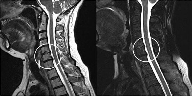 Cervical spine MRI with signs of osteochondrosis