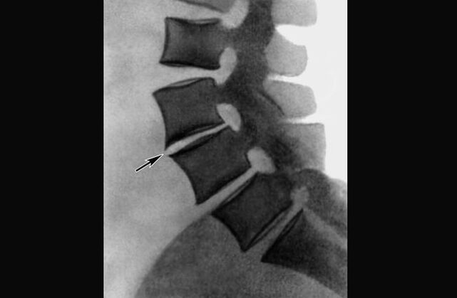 Manifestations of osteochondrosis of the thoracic spine on radiography