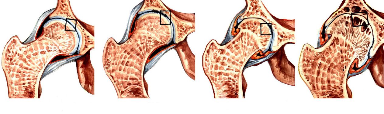 Degrees of coxarthrosis deforming