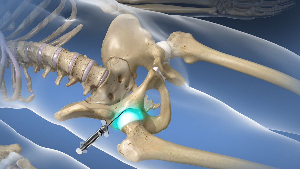 Intra-articular block to eliminate acute pain in coxarthrosis