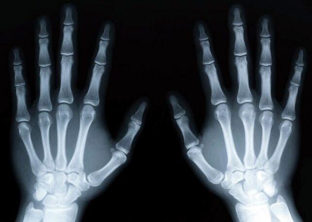 Gout causes the development of gouty arthritis, which can be diagnosed using x-rays