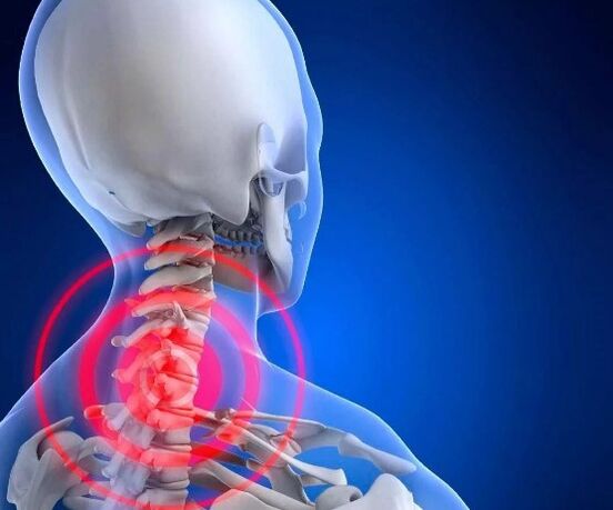 Cervical osteochondrosis